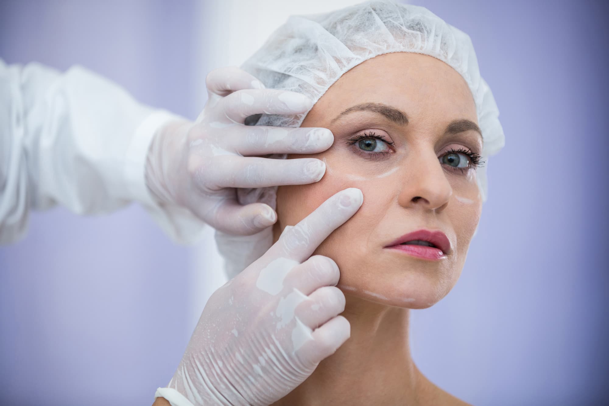 Thread Lifts procedure
